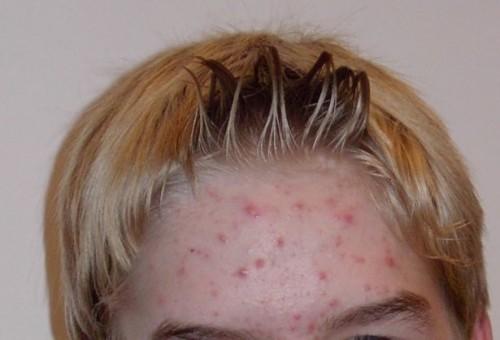 Rougeurs d'acné Cures